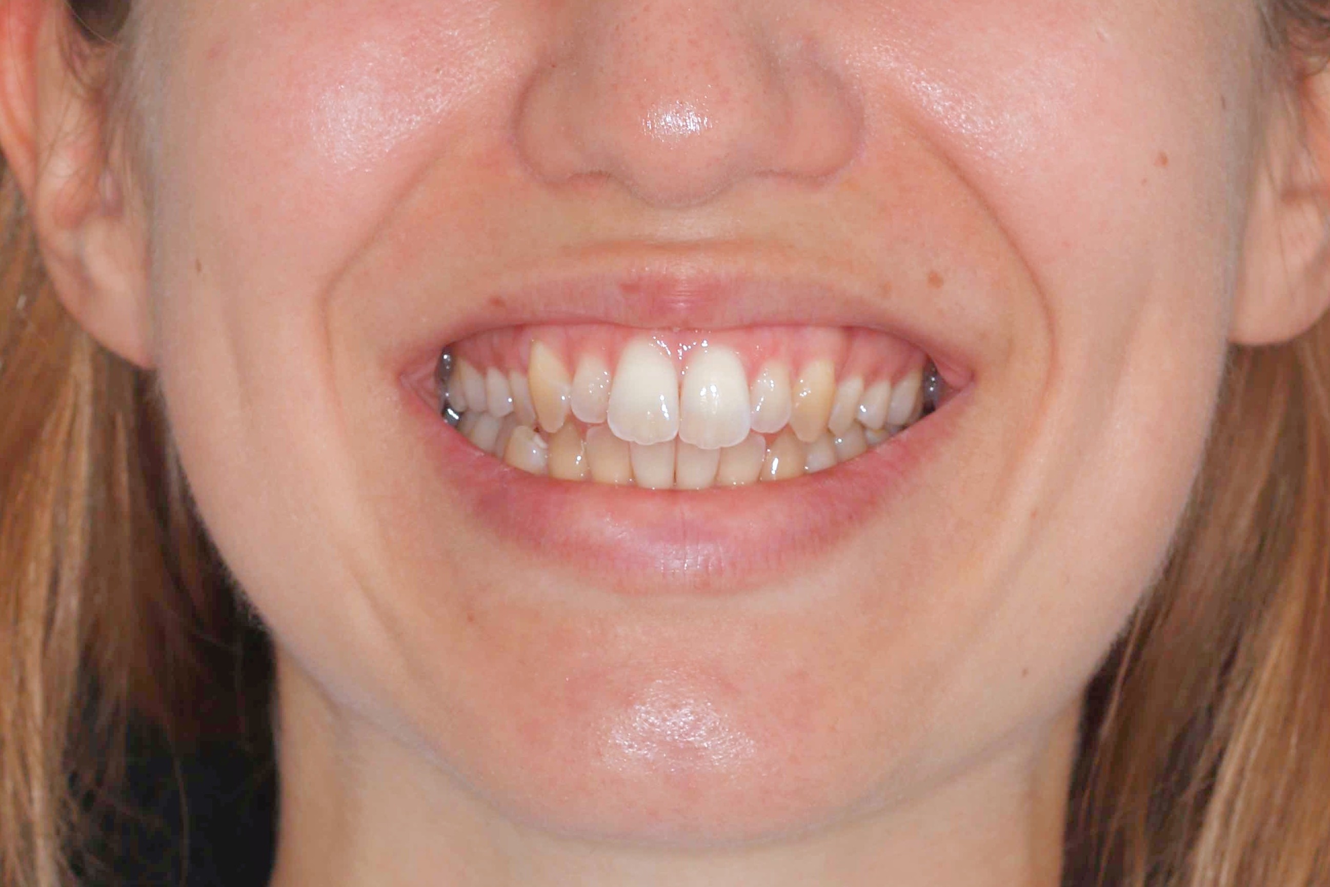 Before orthodontic treatment - Orthodontic Treatment with Clear Aligners