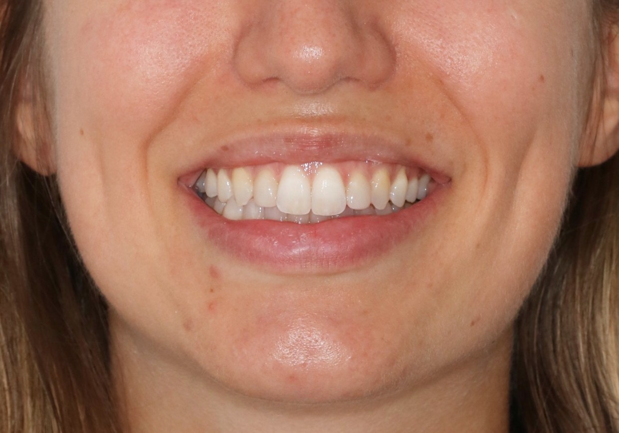 After orthodontic treatment - Orthodontic Treatment with Clear Aligners