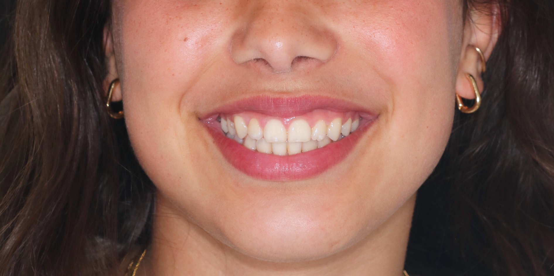 After orthodontic treatment - Expansion with Fixed Appliance and Skeletal Anchorage